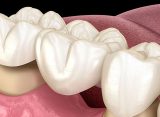tecniche di preparazioni protesiche a confronto: con o senza linea di finitura?