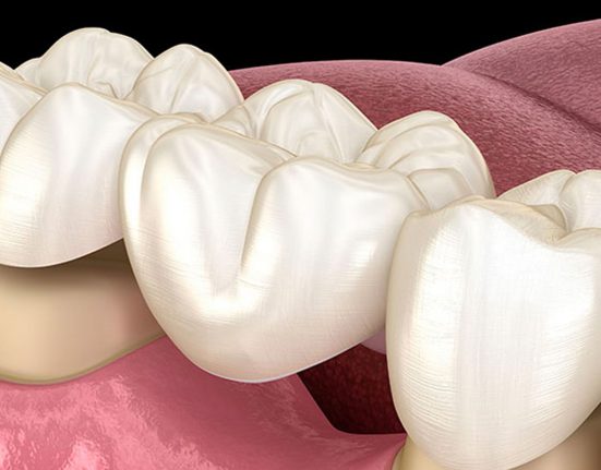 tecniche di preparazioni protesiche a confronto: con o senza linea di finitura?