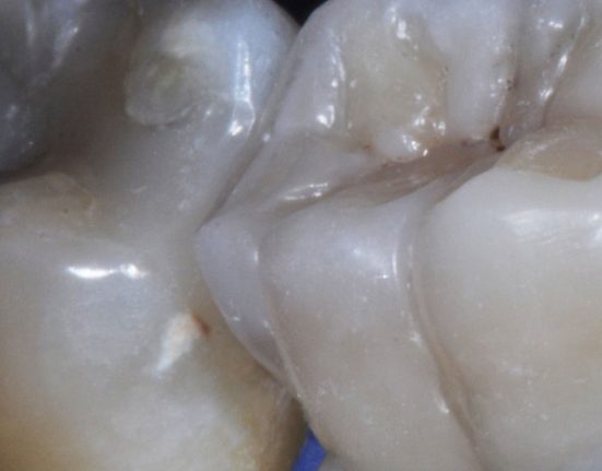 Elemento gravemente compromesso: l’esperienza al servizio di nuove tecnologie analogiche e nuovi materiali, per protocolli semplificati e predicibili