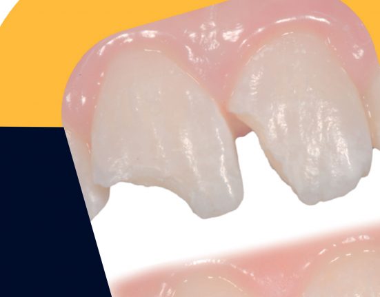 Restauro estetico dei denti anteriori con i materiali compositi Dott. Vanini