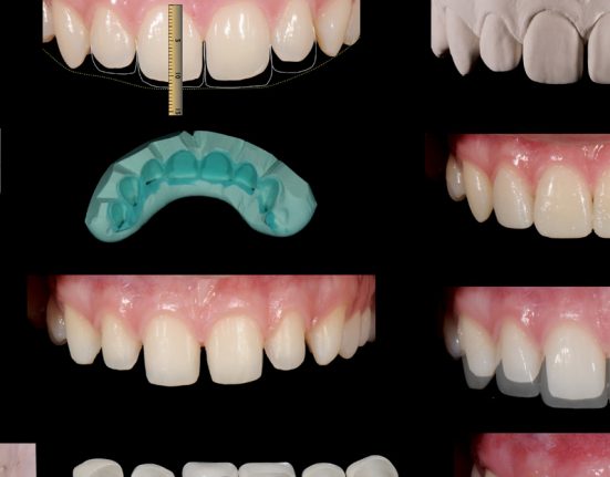 Il lifting del sorriso mediante restauri minimamente invasivi