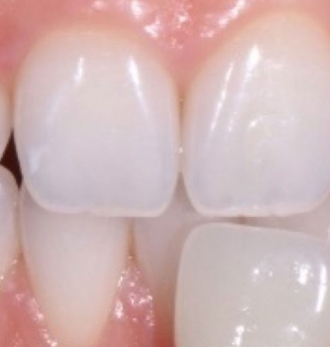 TOOTH WHITENING