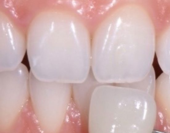 TOOTH WHITENING