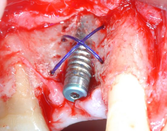 LEMBI NELLE TECNICHE RIGENERATIVE IN IMPLANTOLOGIA (GBR): MATERIALI E TECNICHE INNOVATIVE