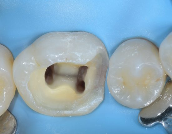 ENDODONZIA BASE IN MICROSCOPIA