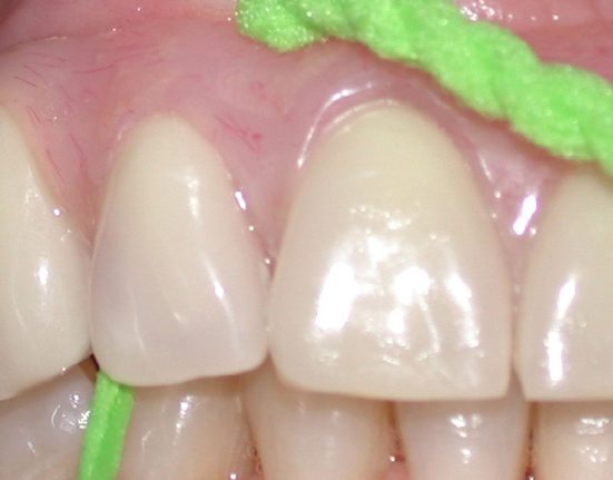Il mantenimento perimplantare: il cambiamento