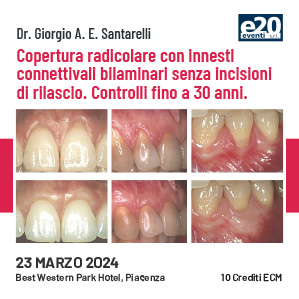 Dr. Santarelli - Copertura radicolare con innesti connettivali bilaminari senza incisioni di rilascio. Controlli fino a 30 anni.