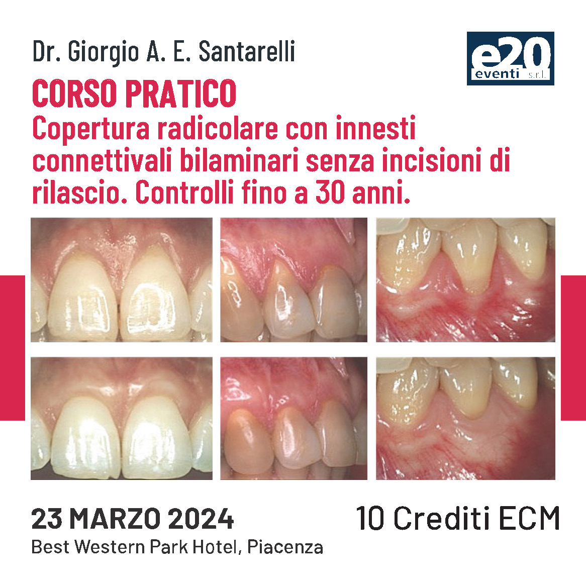 Dr. Santarelli - Corso Pratico - Copertura radicolare con innesti connettivali bilaminari senza incisioni di rilascio. Controlli fino a 30 anni.
