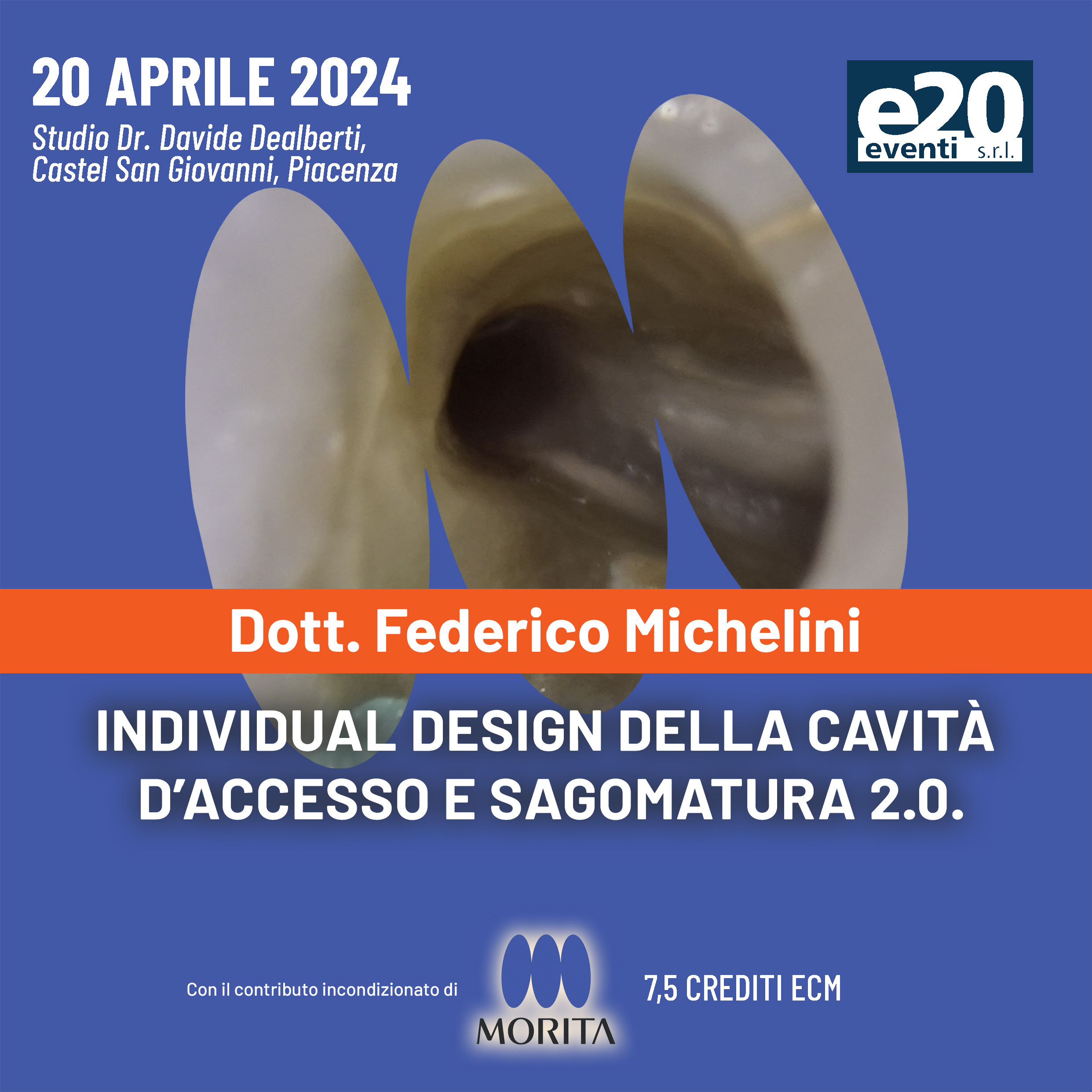 Dott. Michelini - Individual design della cavità  d’accesso e sagomatura 2.0.