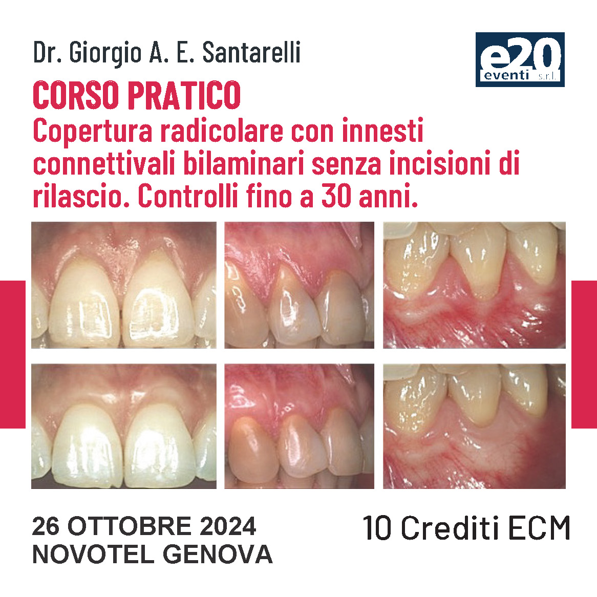 Dr. Santarelli - Corso Pratico - Copertura radicolare con innesti connettivali bilaminari senza incisioni di rilascio. Controlli fino a 30 anni.