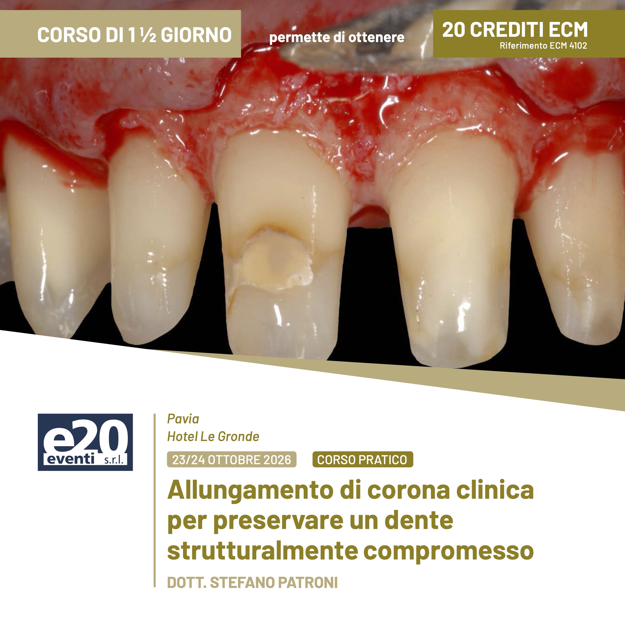 Dott. Patroni - Corso Pratico ALLUNGAMENTO DI CORONA CLINICA PER PRESERVARE UN DENTE STRUTTURALMENTE COMPROMESSO - Pavia