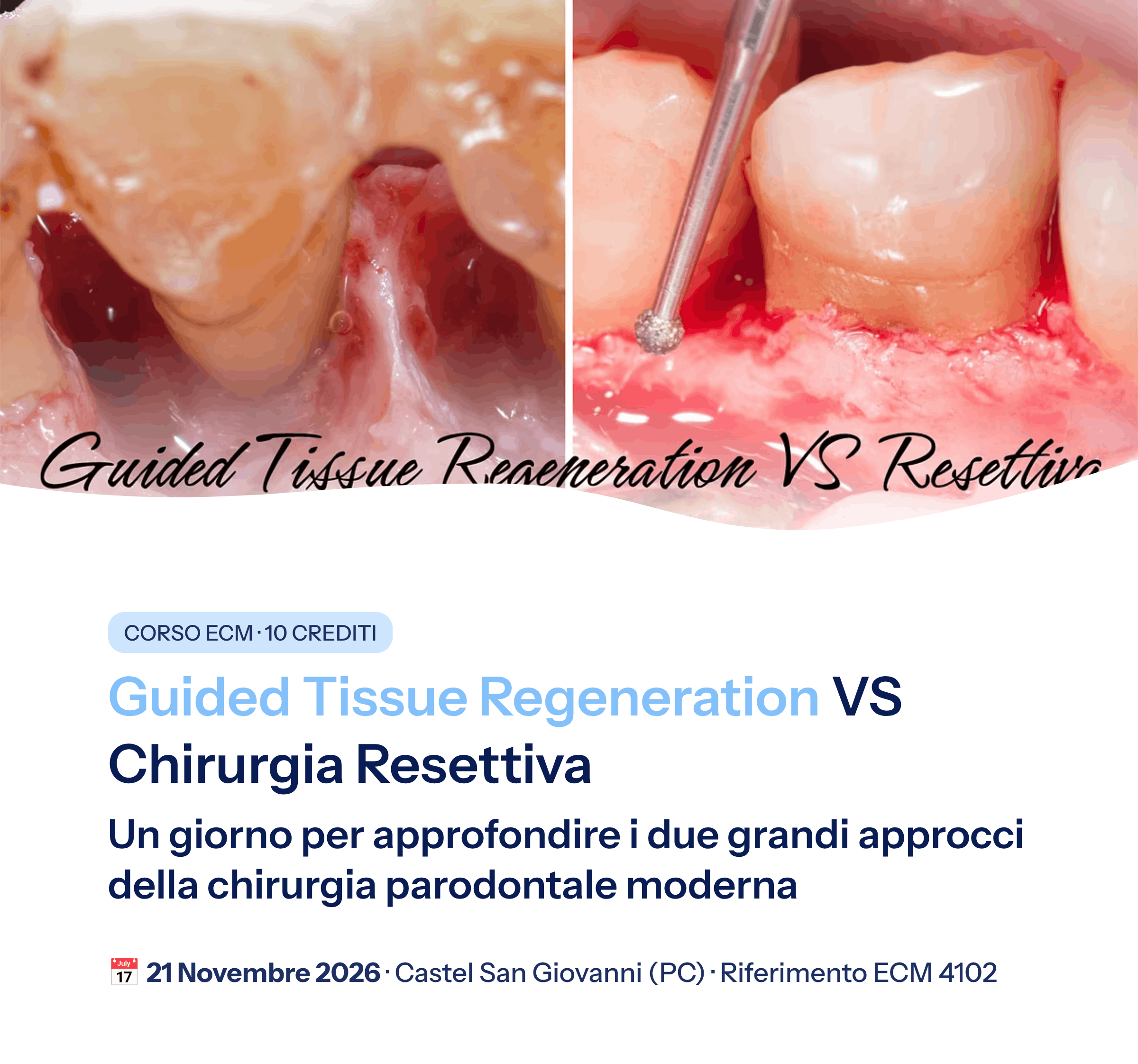 1_Guided-Tissue-Regeneration-VS-Chirurgia-Resettiva