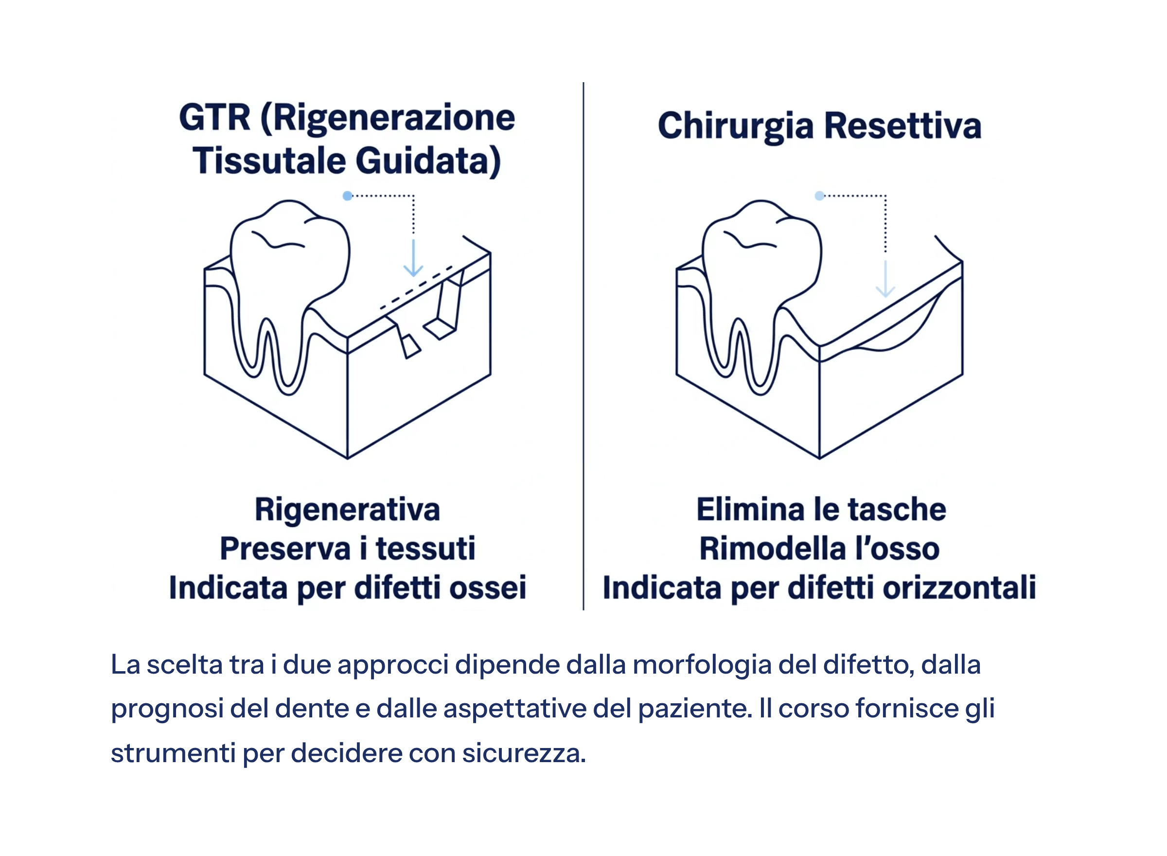 4_La-scelta-tra-i-due-approcci-dipende-dalla-morfologia-del-difetto-dalla-prognosi-del-dente-e-dalle-a